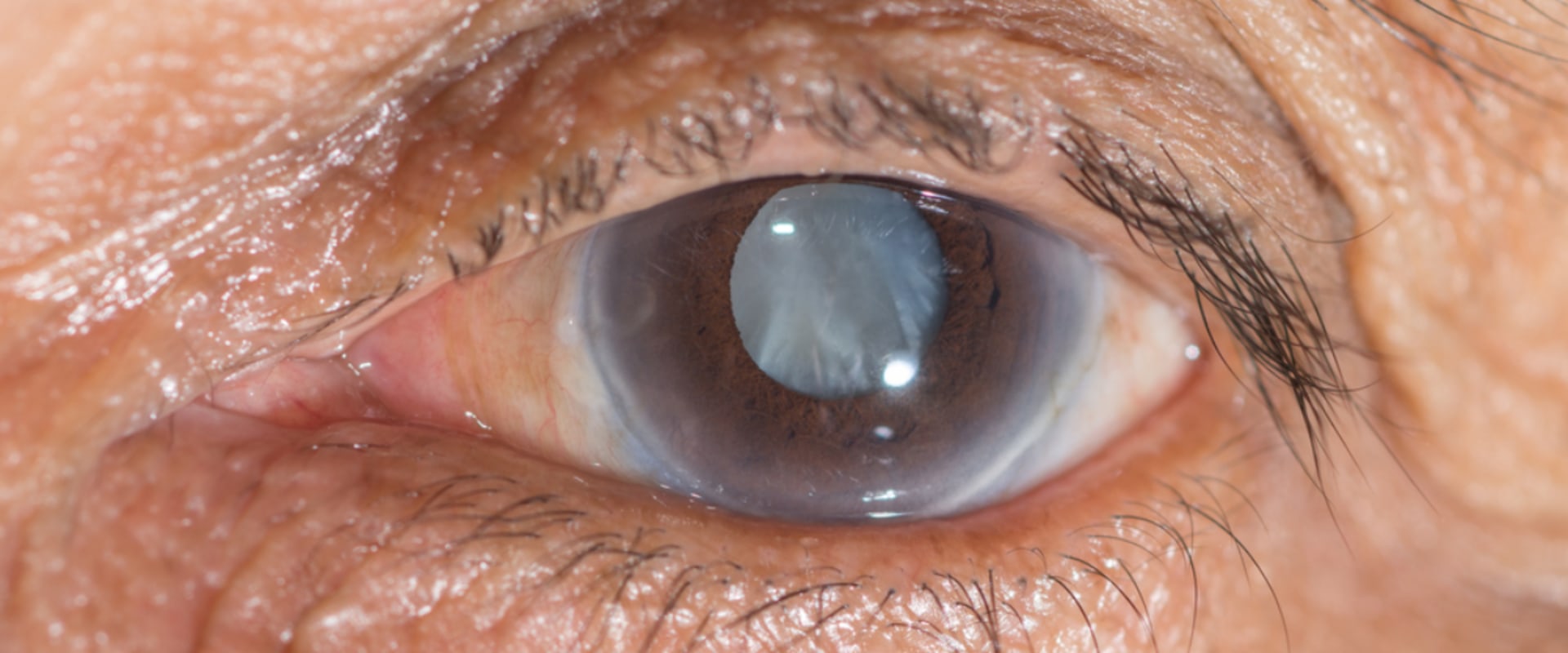 can-eye-doctor-see-cataracts