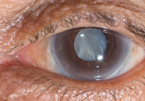 Can an Eye Doctor Detect Cataracts?